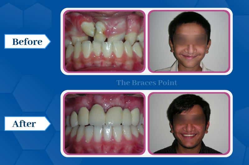 After Cleft Lip And Palate Surgery (1)