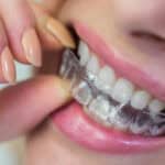 Braces Vs Invisalign Find Out Which One Is Better For You