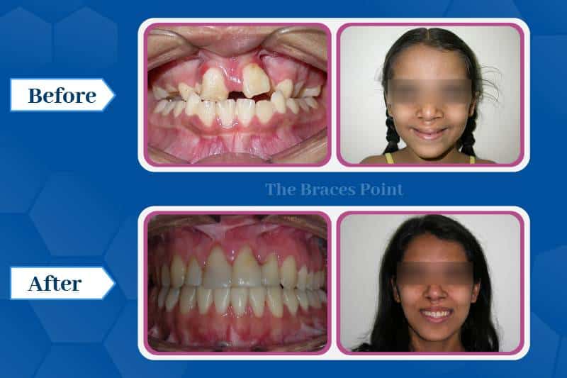 Cleft Lip And Palate