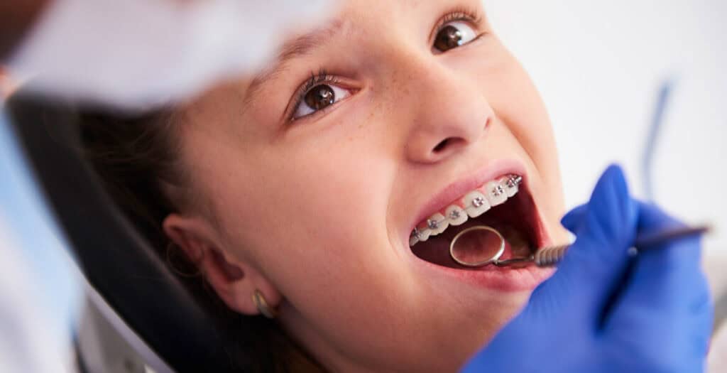 Comprehensive Guide To Braces For Kids