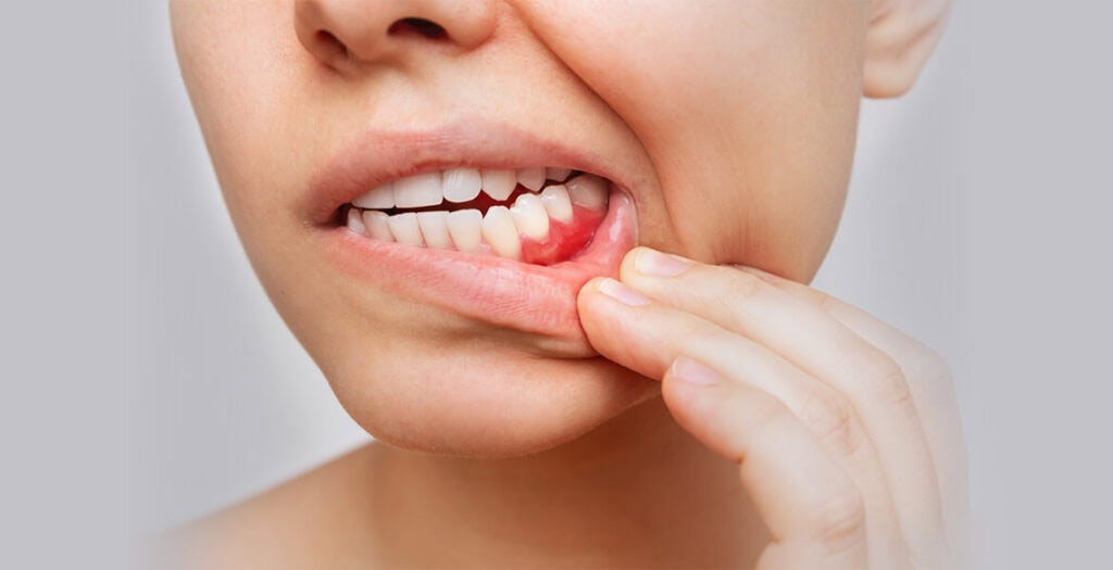 Top 5 Causes Of Bleeding Gums That Everyone Should Know