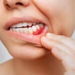 Top 5 Causes Of Bleeding Gums That Everyone Should Know