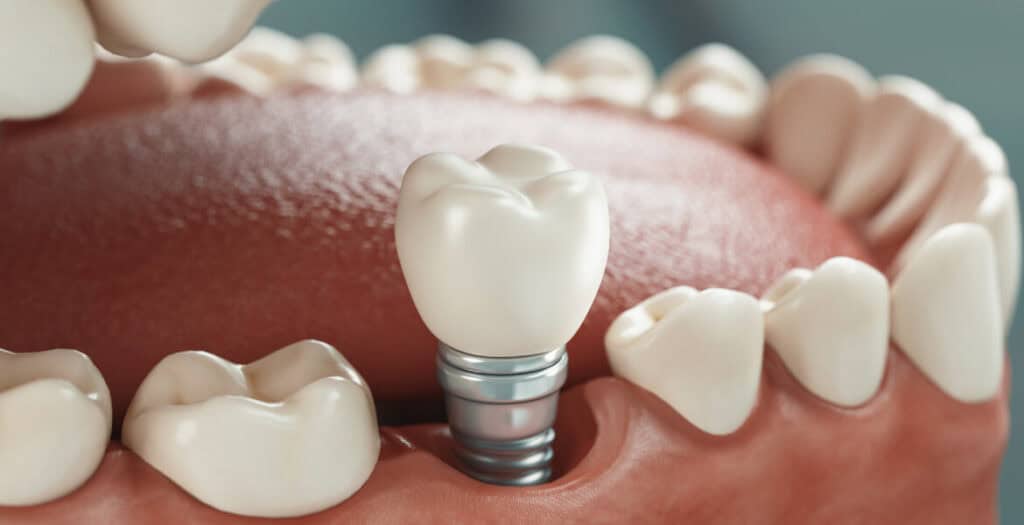 Dental Implants For Missing Teeth