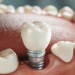 Dental Implants For Missing Teeth